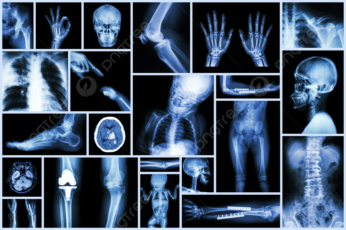 Simple Understand Brittle Bones (Osteogenesis Imperfecta) 3 Simple Understand Brittle Bones (Osteogenesis Imperfecta)