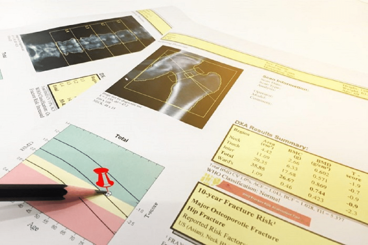 Valuable Z Score Vs T Score DEXA: How Do They Differ?