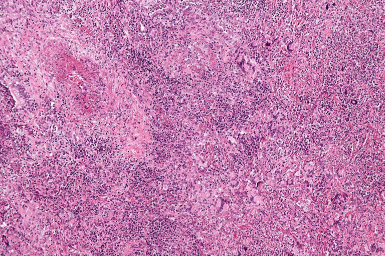 Crucial 5 Types Of ANCA Vasculitis: Causes & Symptoms