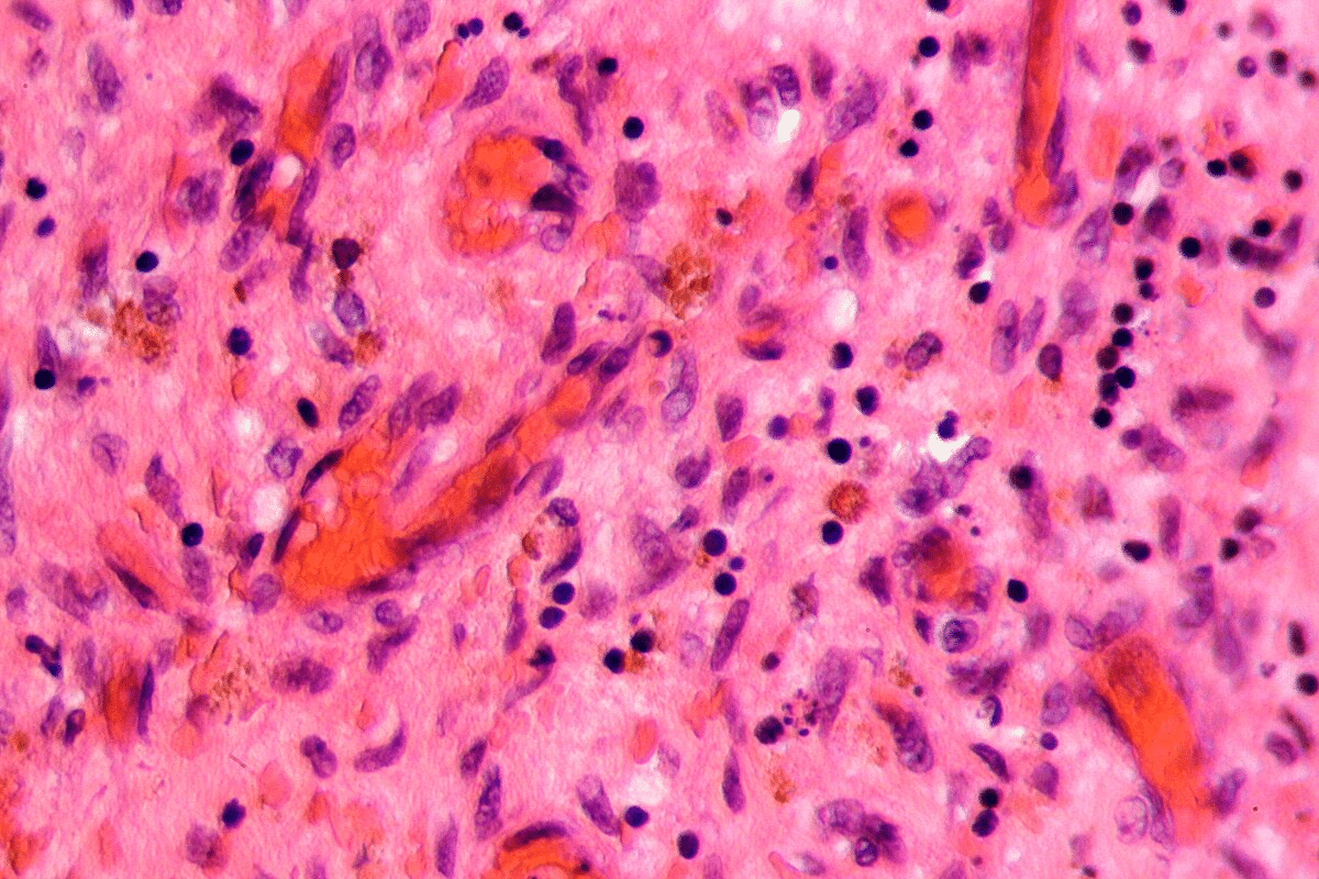 Guide 5 Signs When Why Does My Veins Hurt In My Arms?