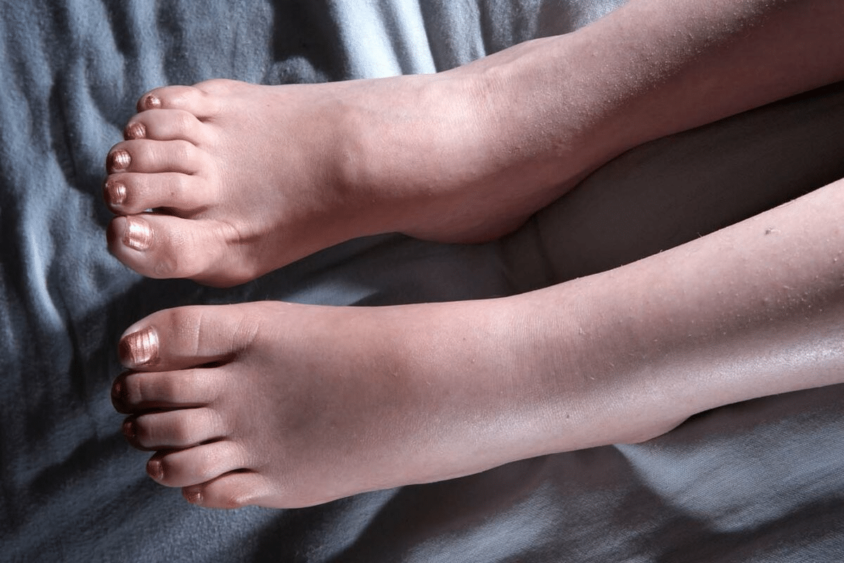 Crucial Why Are Bulging Veins In Feet Occurring?