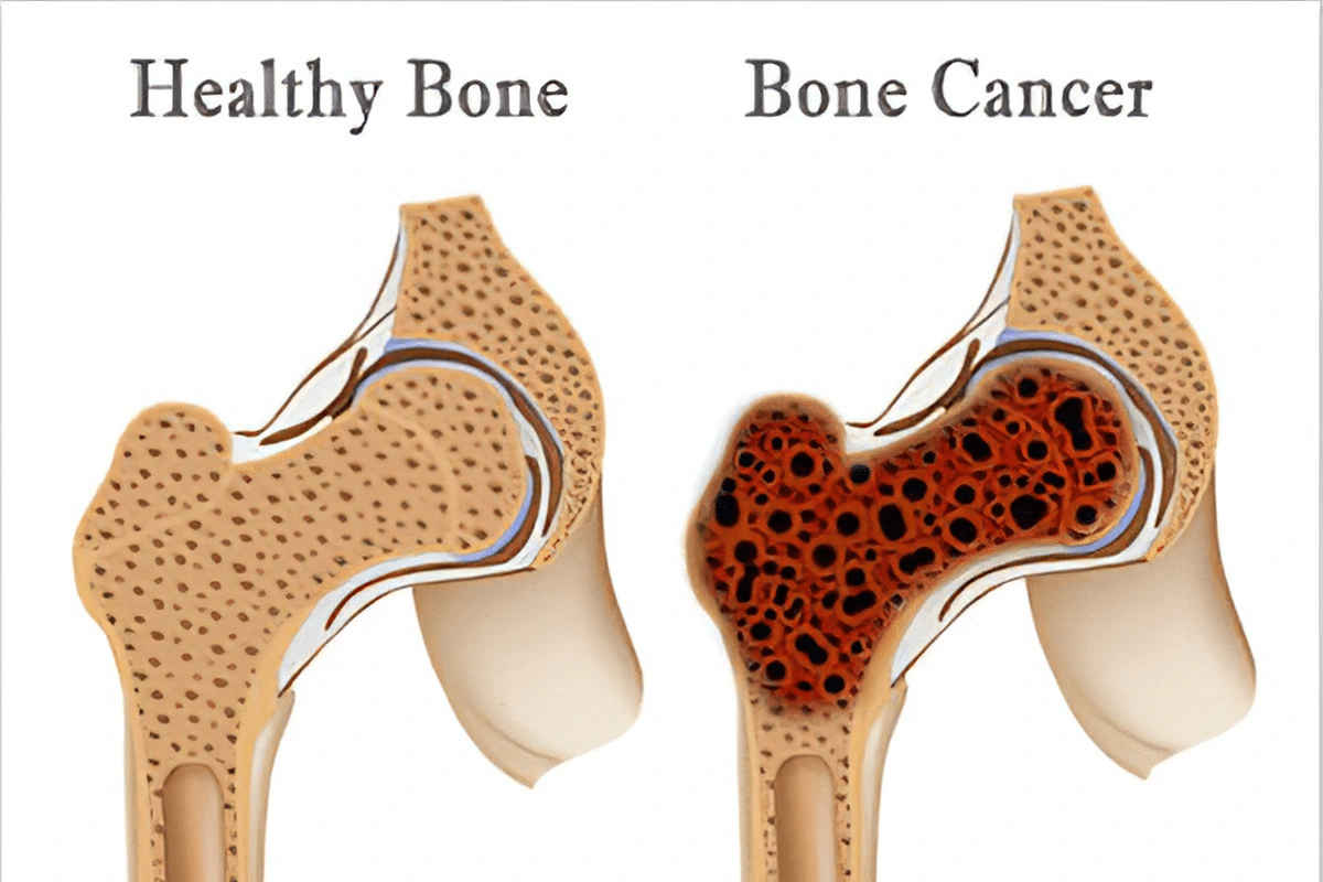 Fascinating What Does Bone Pain In Legs Feel Like?