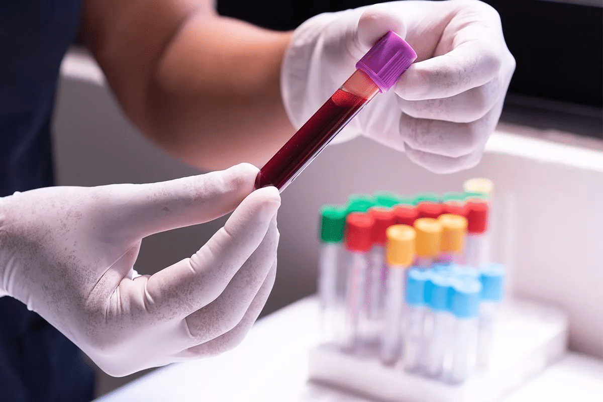 Valuable What Blood Test Detects Lupus: Diagnostic Guide 1 Valuable What Blood Test Detects Lupus: Diagnostic Guide
