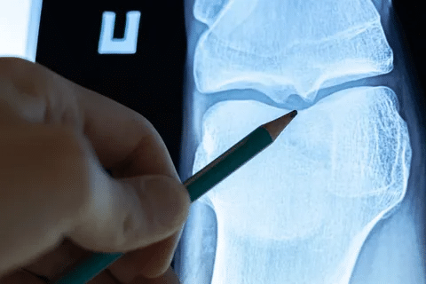 Essential Can A Bone Density Scan Detect Cancer? 3 Essential Can A Bone Density Scan Detect Cancer?