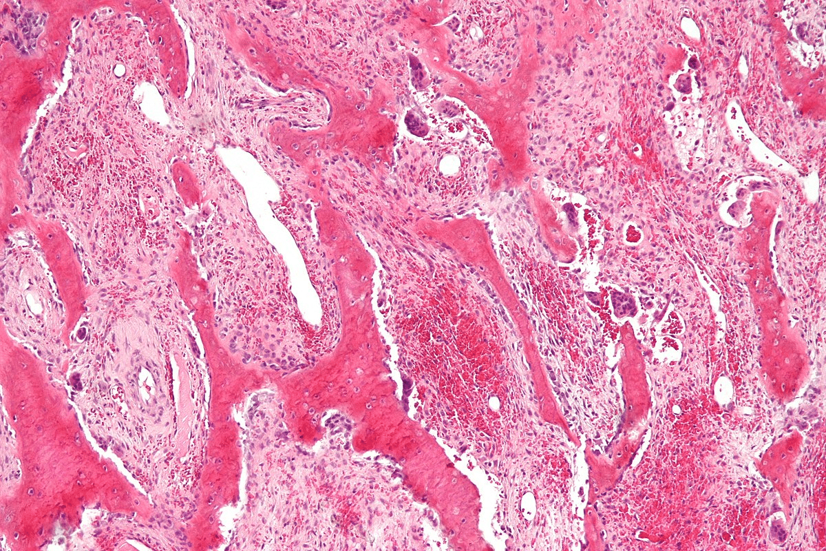 Key Can A DEXA Scan Show Bone Cancer?