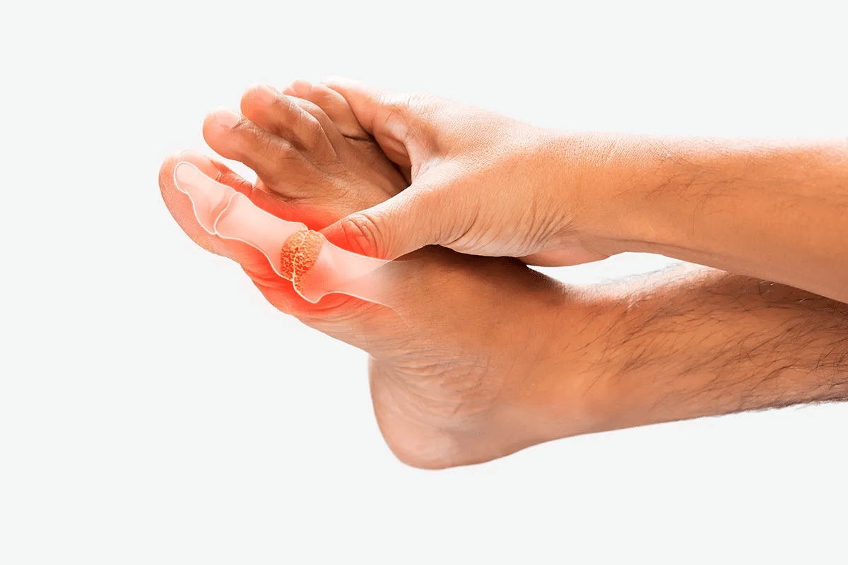Key How To Treat Arthritic Toes: Relief Guide 1 Key How To Treat Arthritic Toes: Relief Guide