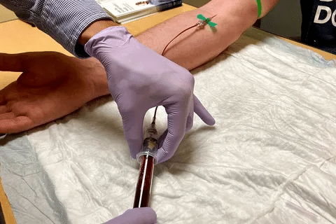 Fascinating Is There A Blood Test For Lupus? Guide 2 Fascinating Is There A Blood Test For Lupus? Guide