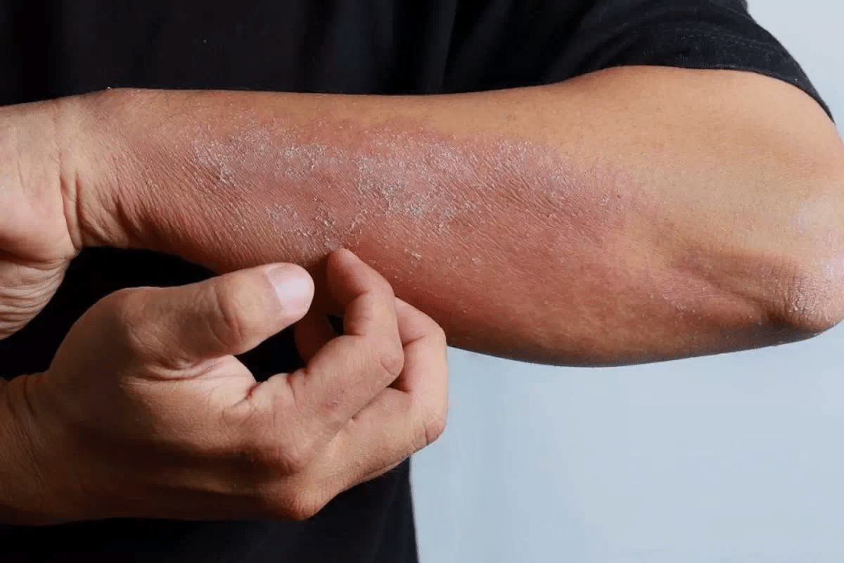 Can Benadryl Help Rashes? Critical Facts