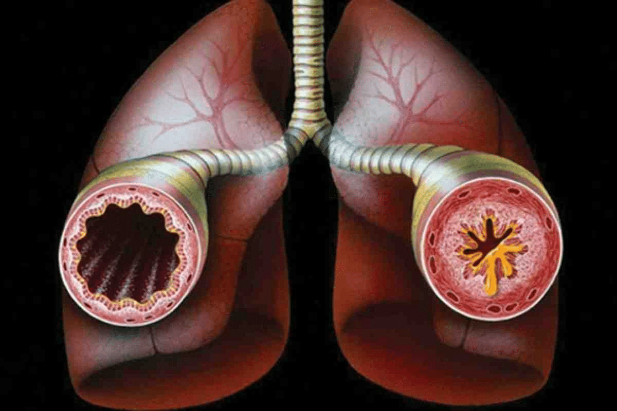 Can You Get Bronchitis From Allergies? Facts