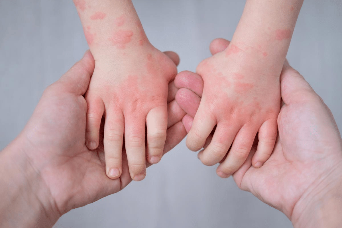 Does Benadryl Help With Rashes? Best Use