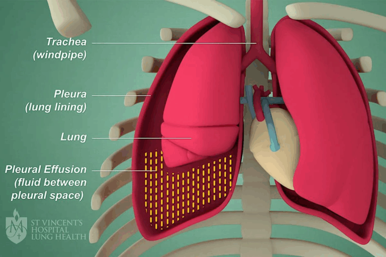 Insightful Chronic Bronchitis Pathophysiology & Etiology