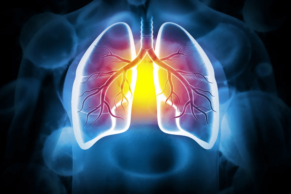 Valuable Acute Exacerbation Of COPD: How It Develops