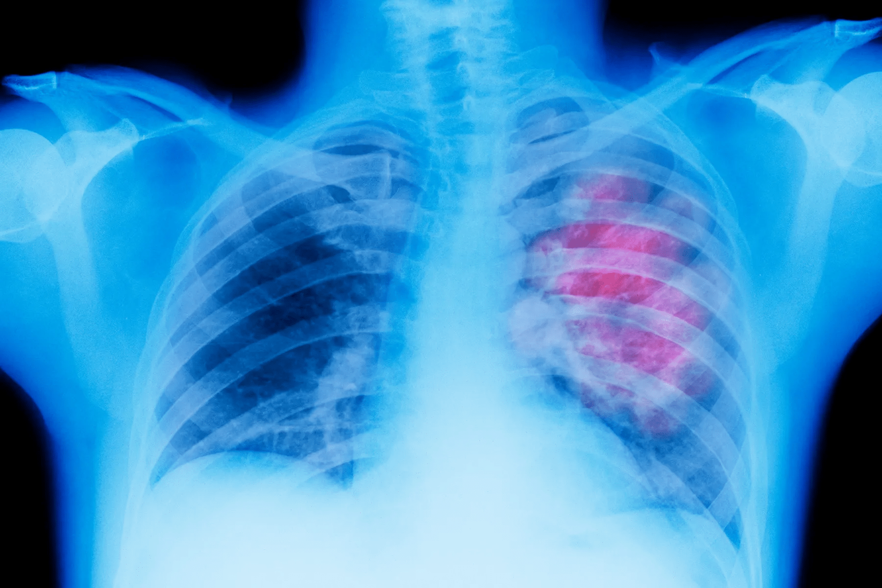 Signs That Pneumonia Is Improving: 4 Stages