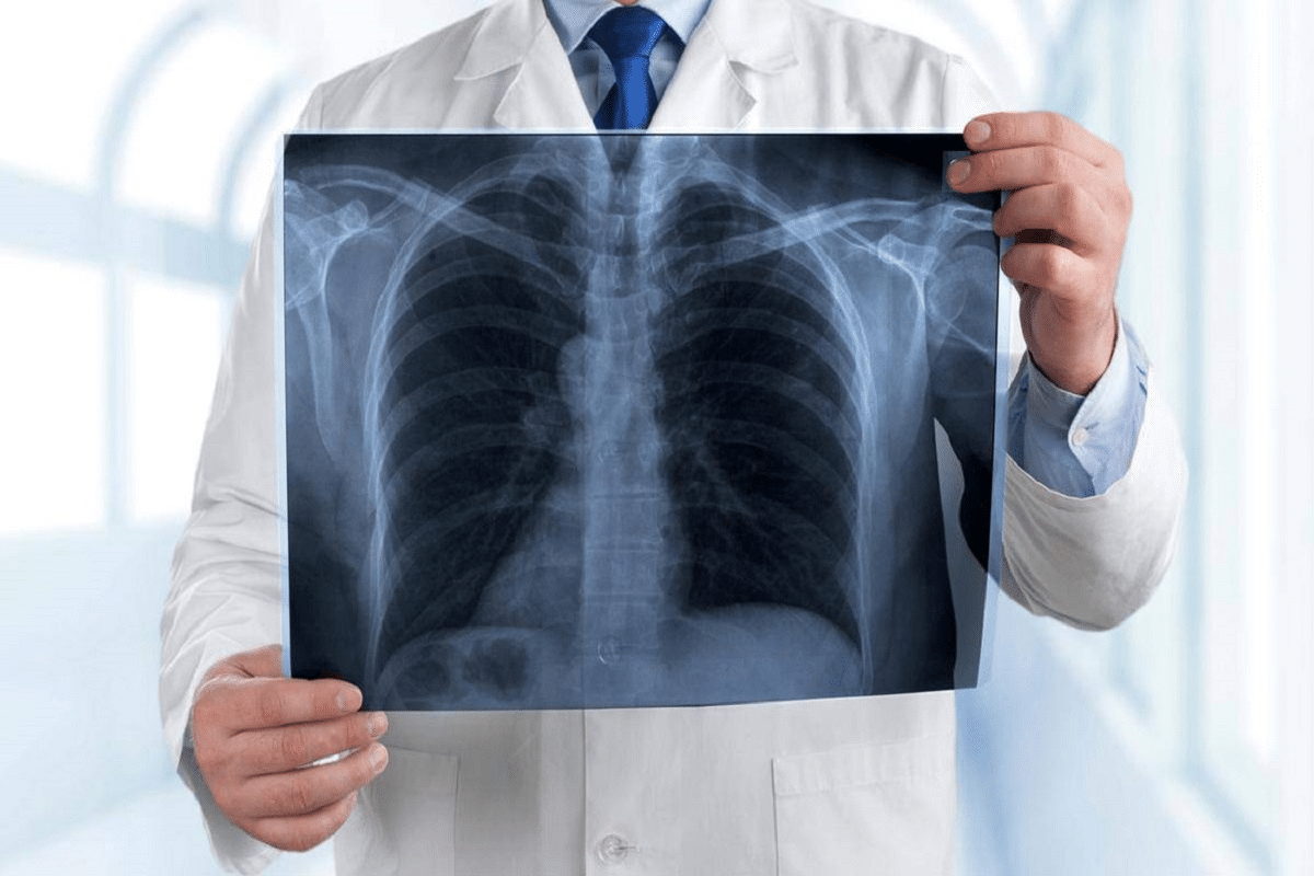 Essential 5 Key Differences Between COPD Vs Pneumonia