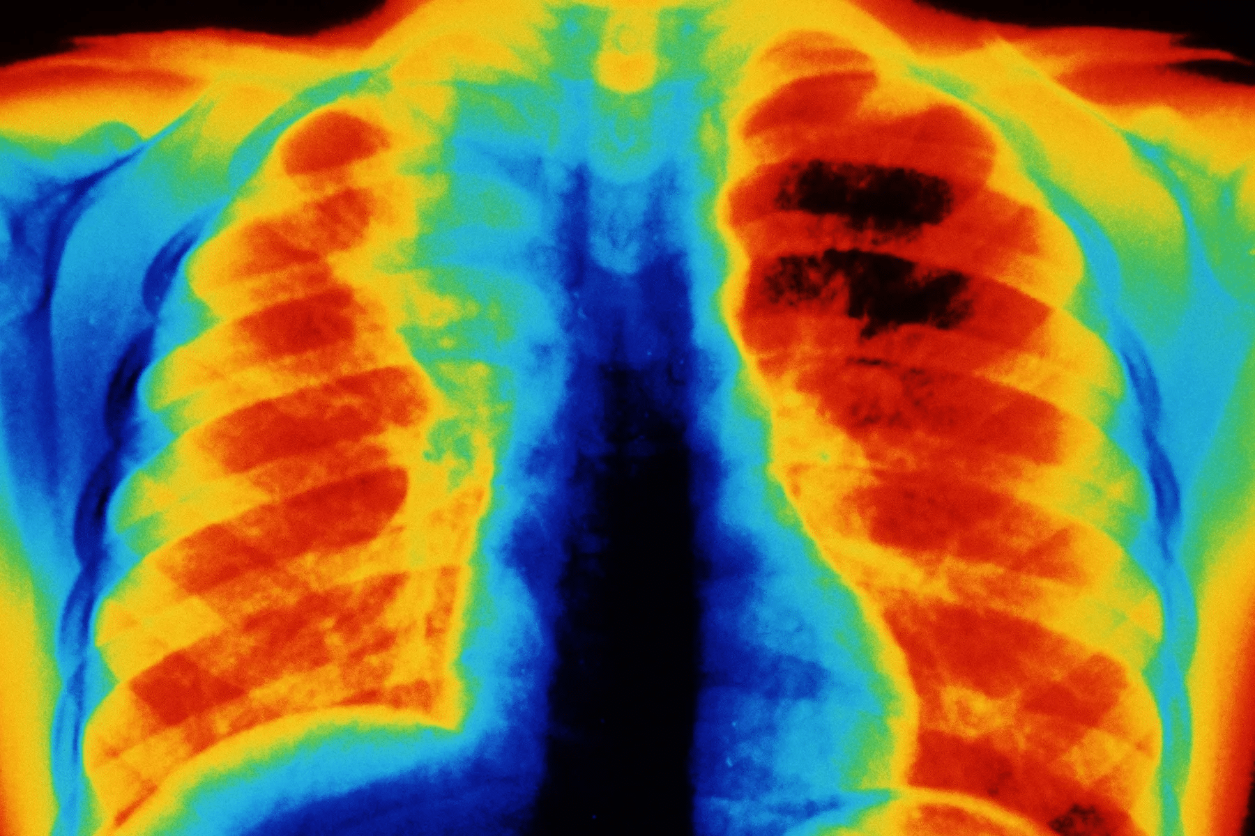 Pneumonia Symptoms: 7 Critical Warning Signs