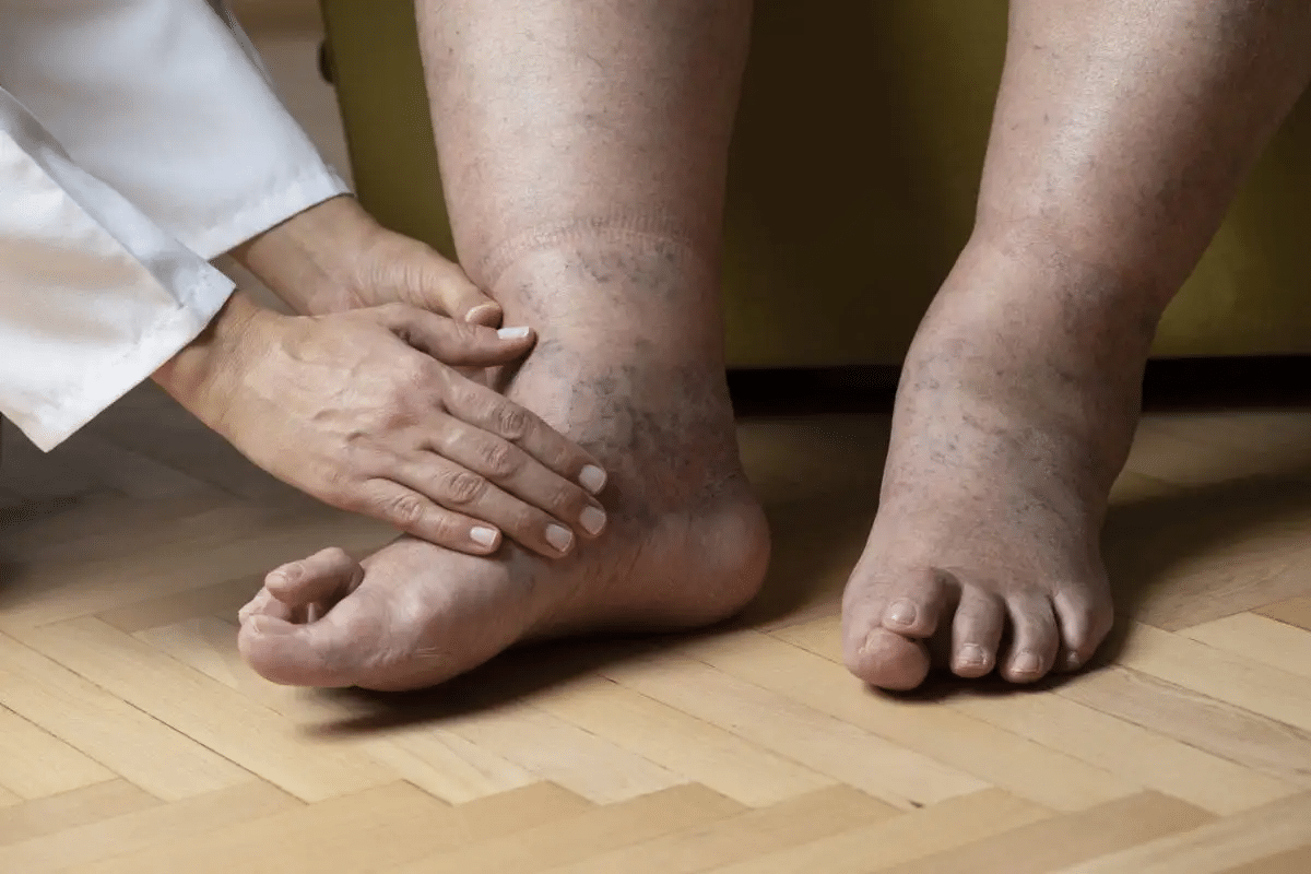 Sharp Why End Stage COPD Swelling Feet Develop?