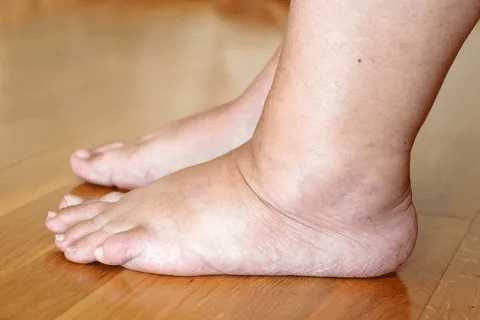 Key Why Does COPD And Water Retention Cause Swollen Feet And Edema?