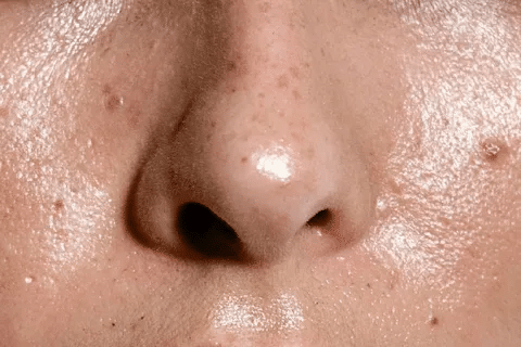 Simple Why Is My Nose Clogged: Causes & Solutions