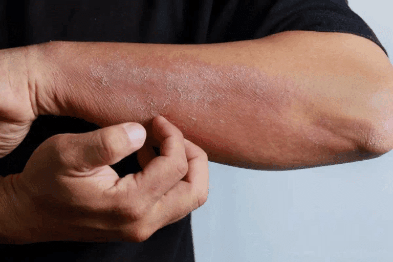 Allergic Reaction: Fast Signs & Treatment