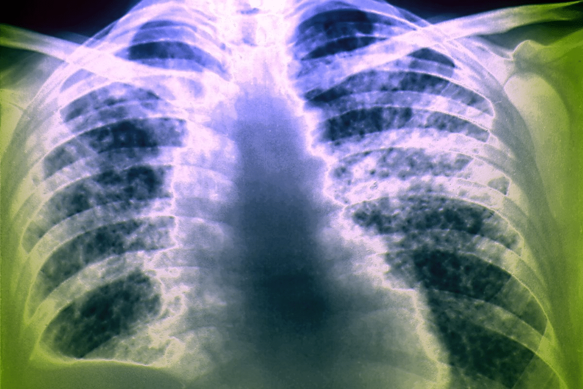 Key Can Chest Scan For Pneumonia Detect It Clearly?
