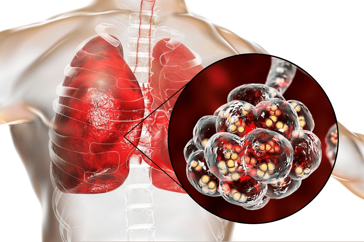 Profound Pneumonia Chest X Ray Vs Normal Comparison 2 Profound Pneumonia Chest X Ray Vs Normal Comparison