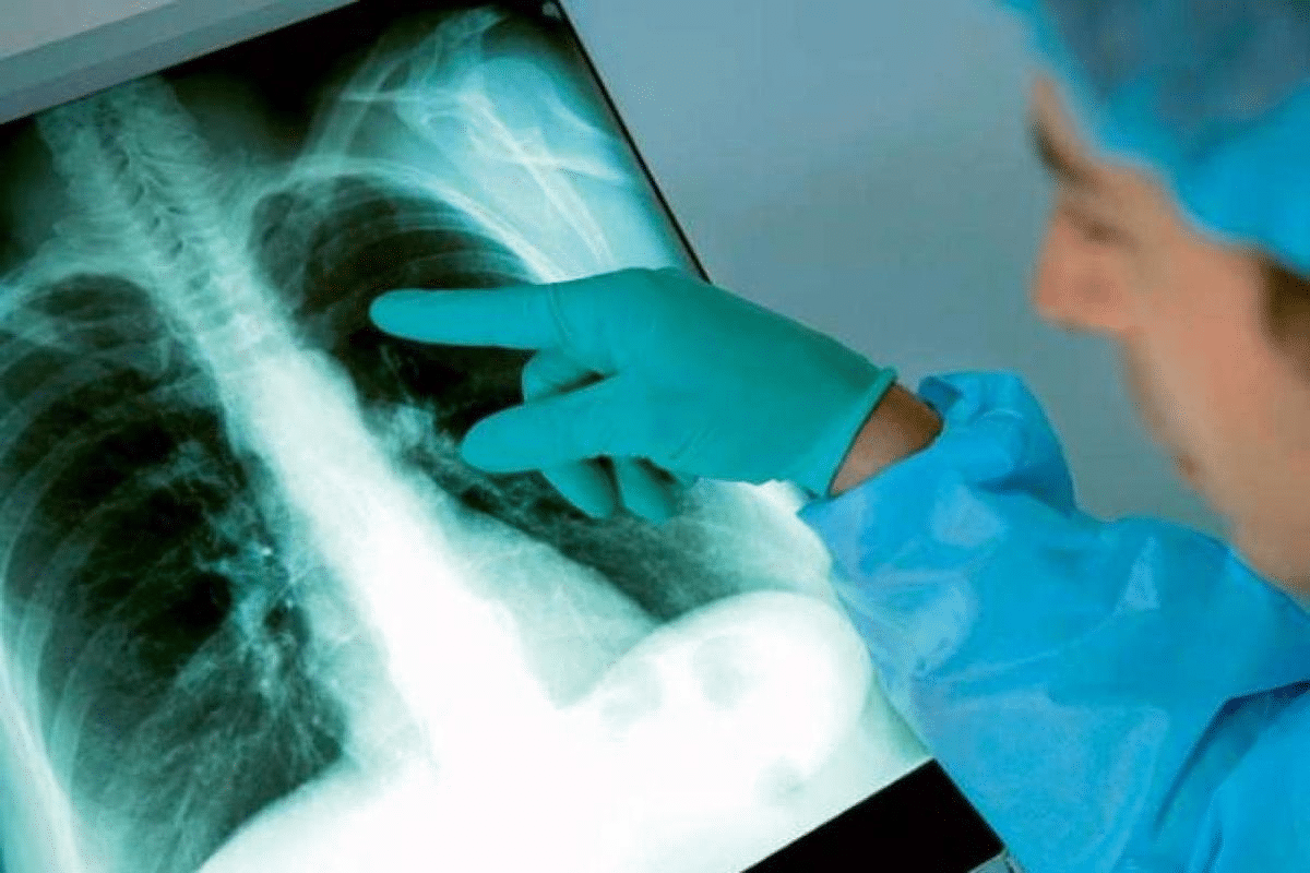 Profound Pneumonia Chest X Ray Vs Normal Comparison 1 Profound Pneumonia Chest X Ray Vs Normal Comparison