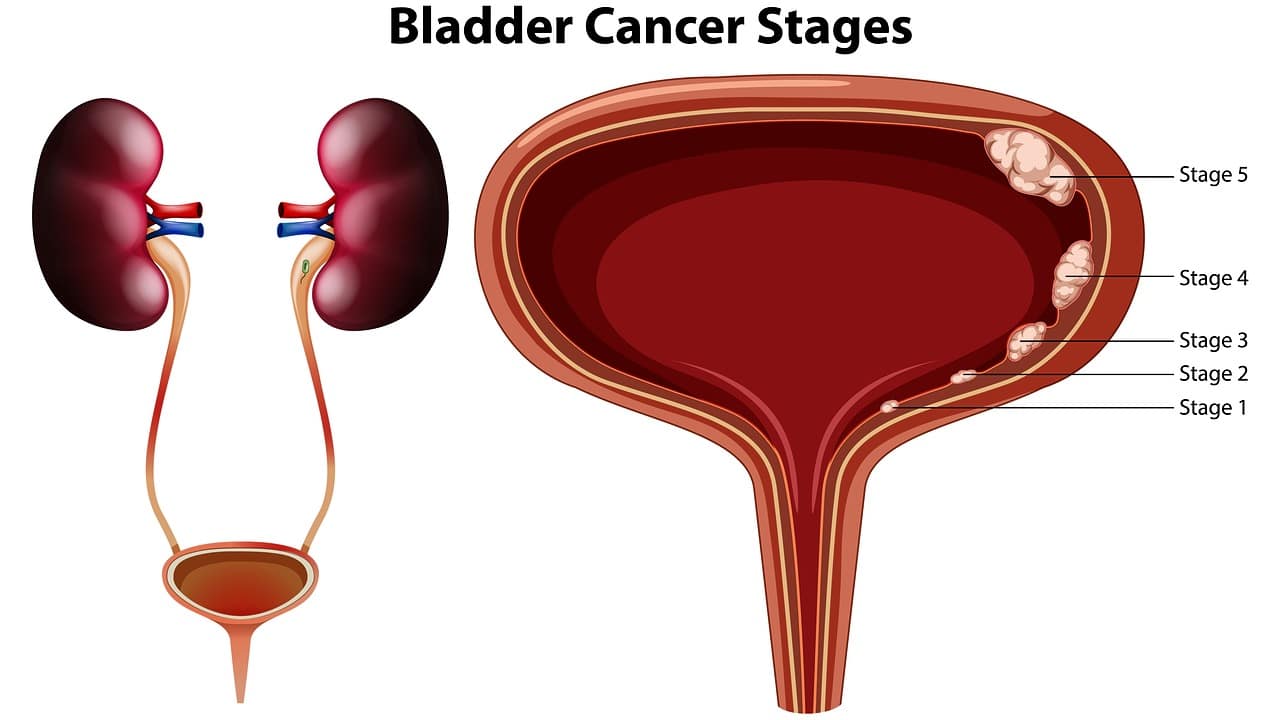 BCG Therapy for Bladder Cancer