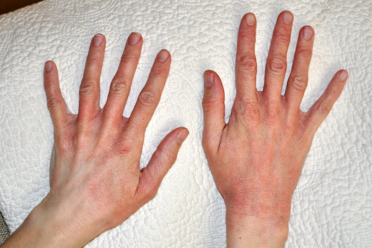 Profound Treat Allergic Contact Dermatitis Lips