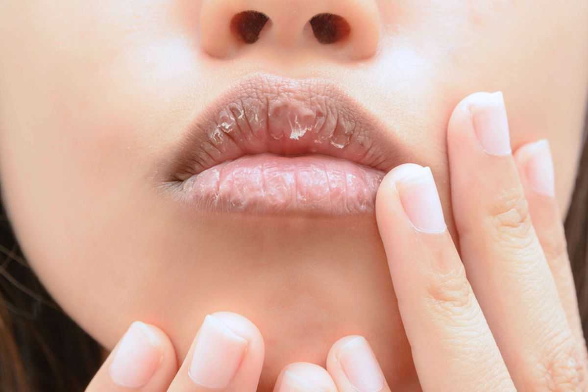 Fascinating How To Treat Contact Dermatitis Lips Relief