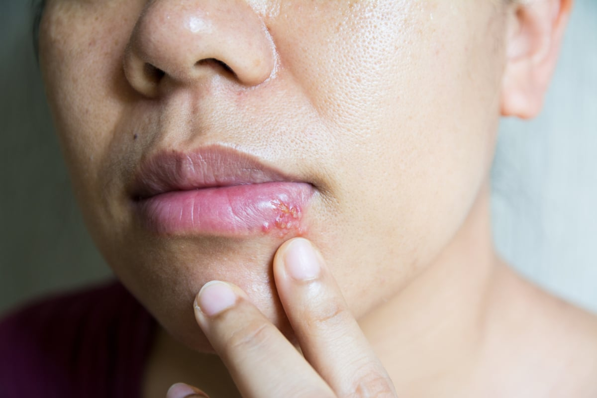 Fascinating How To Treat Contact Dermatitis Lips Relief