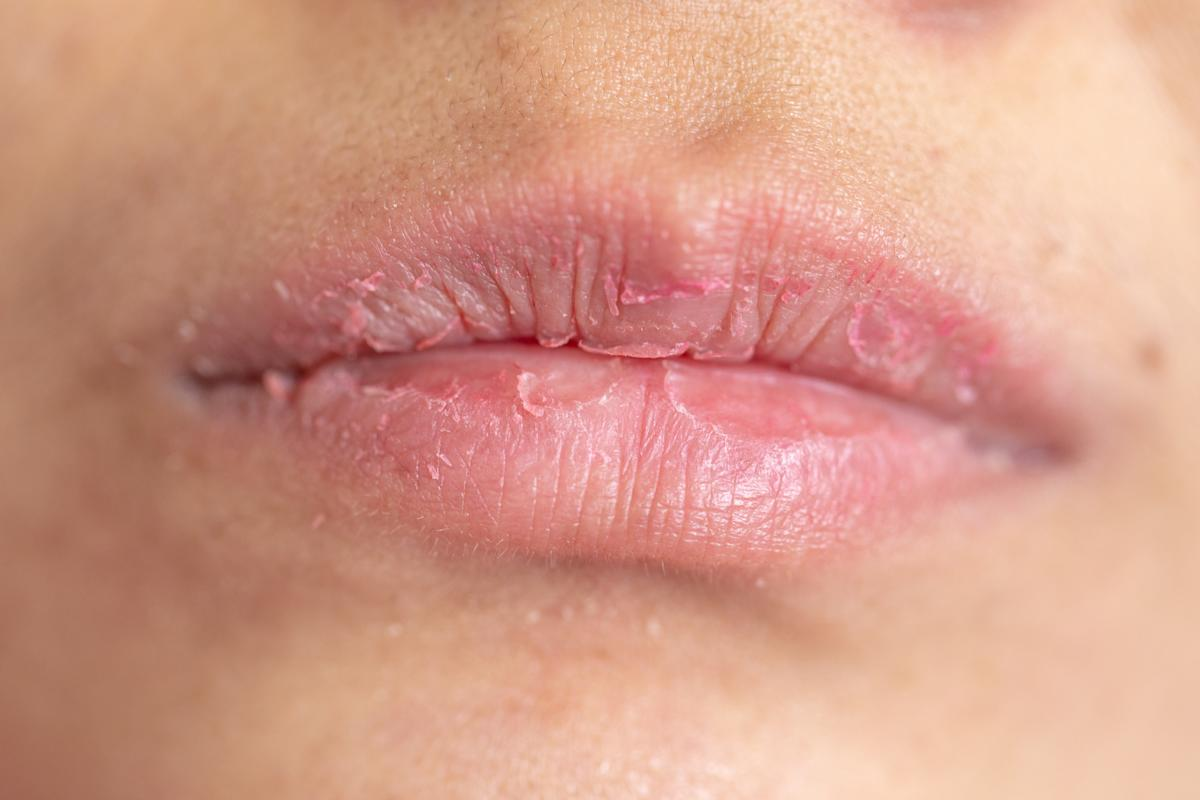 Fascinating How To Treat Contact Dermatitis Lips Relief