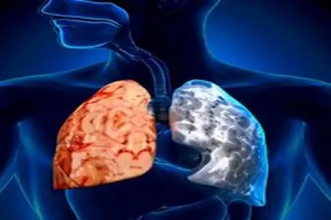 Ultimate 4 COPD Categories: GOLD Guide 1 Ultimate 4 COPD Categories: GOLD Guide