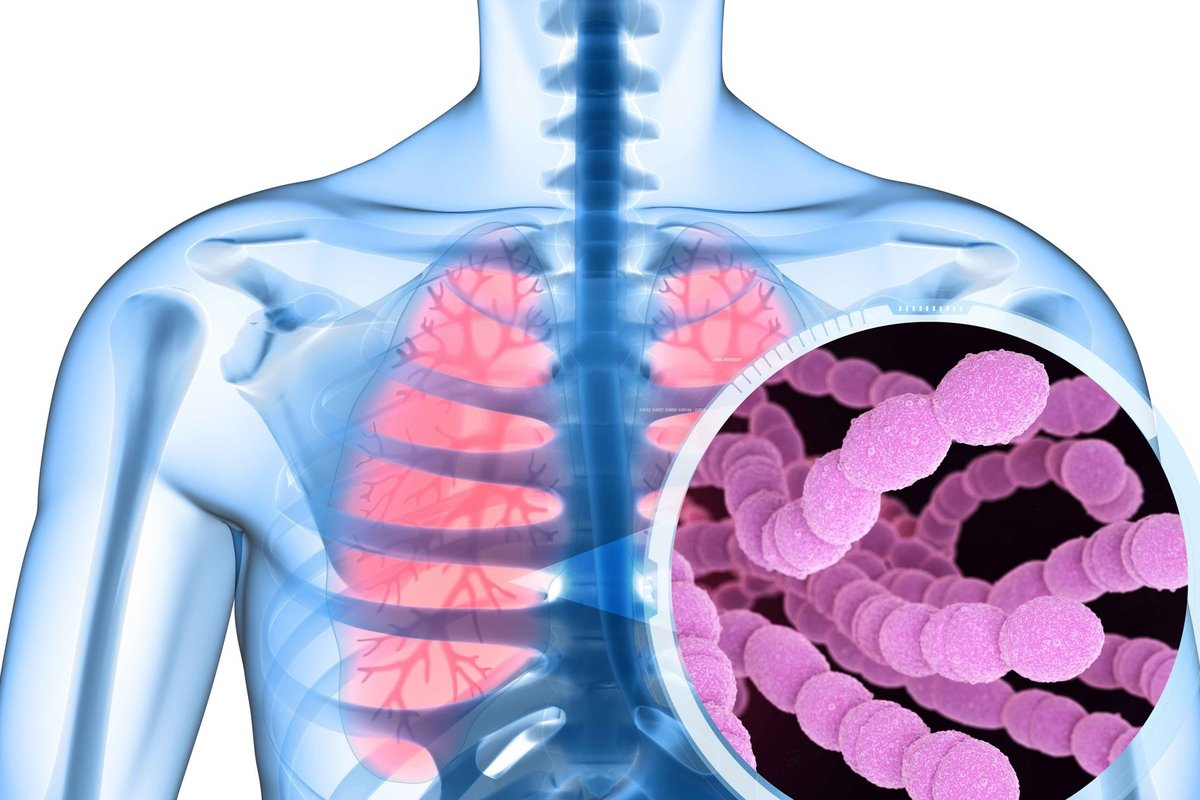 Pneumococcal Pneumonia Treatment: Best Guide