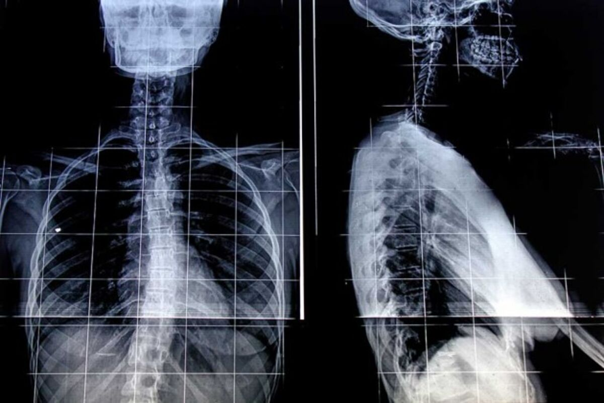 Fascinating X Ray Of Pneumonia Vs Normal Comparison