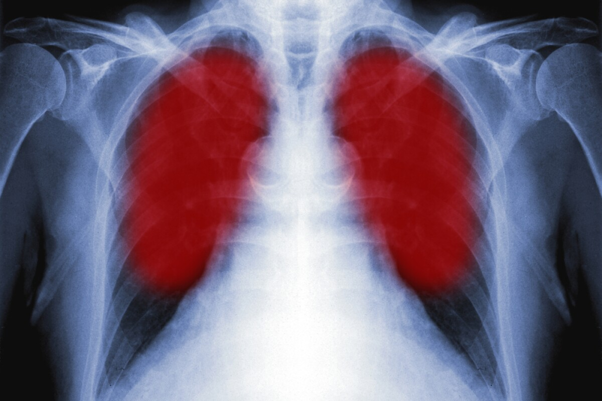 Sharp What Can Be Diagnosed With A Chest X Ray?