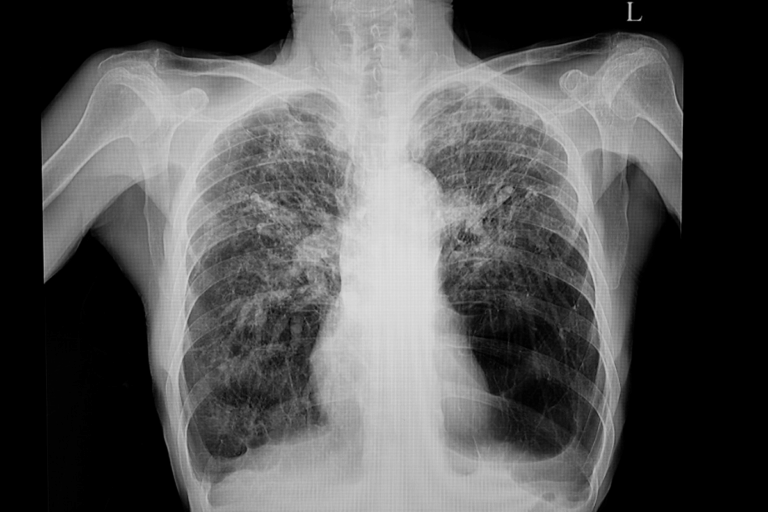 Can COPD Lead to Death? Critical Facts