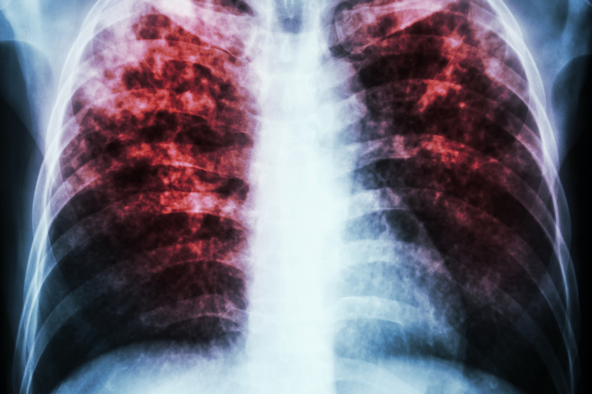 Average Lifespan of Someone With COPD: Facts 1 Average Lifespan of Someone With COPD: Facts