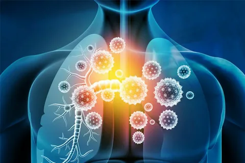 Ultimate Define Chronic Bronchitis: Pathology