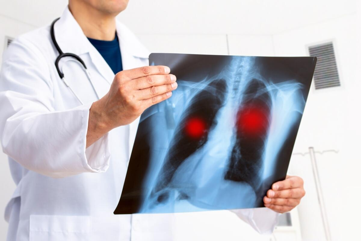 Guide What Do Normal Lungs X Ray Images Show? 1 Guide What Do Normal Lungs X Ray Images Show?