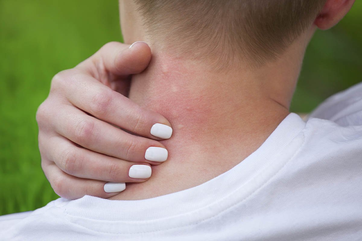 Are Hives Contagious? Vital Safety Facts