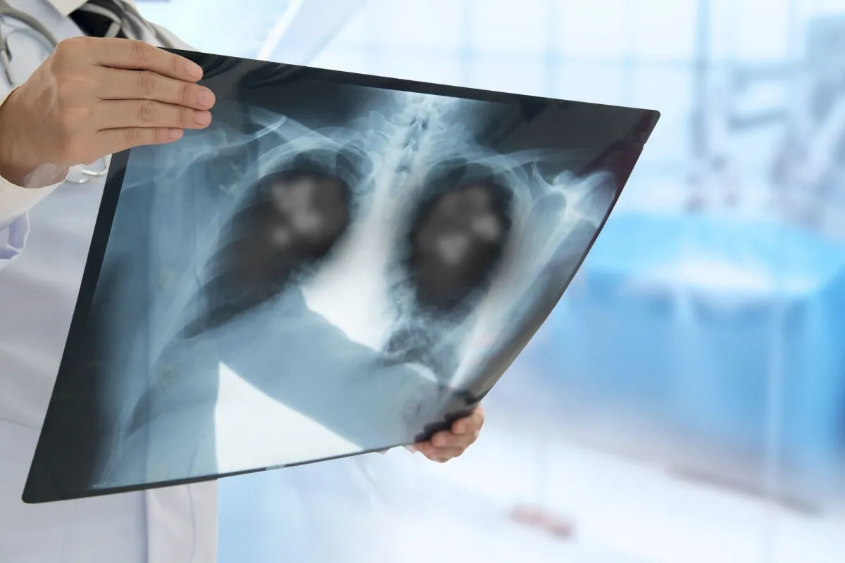 Mild COPD Life Expectancy: Best Prognosis