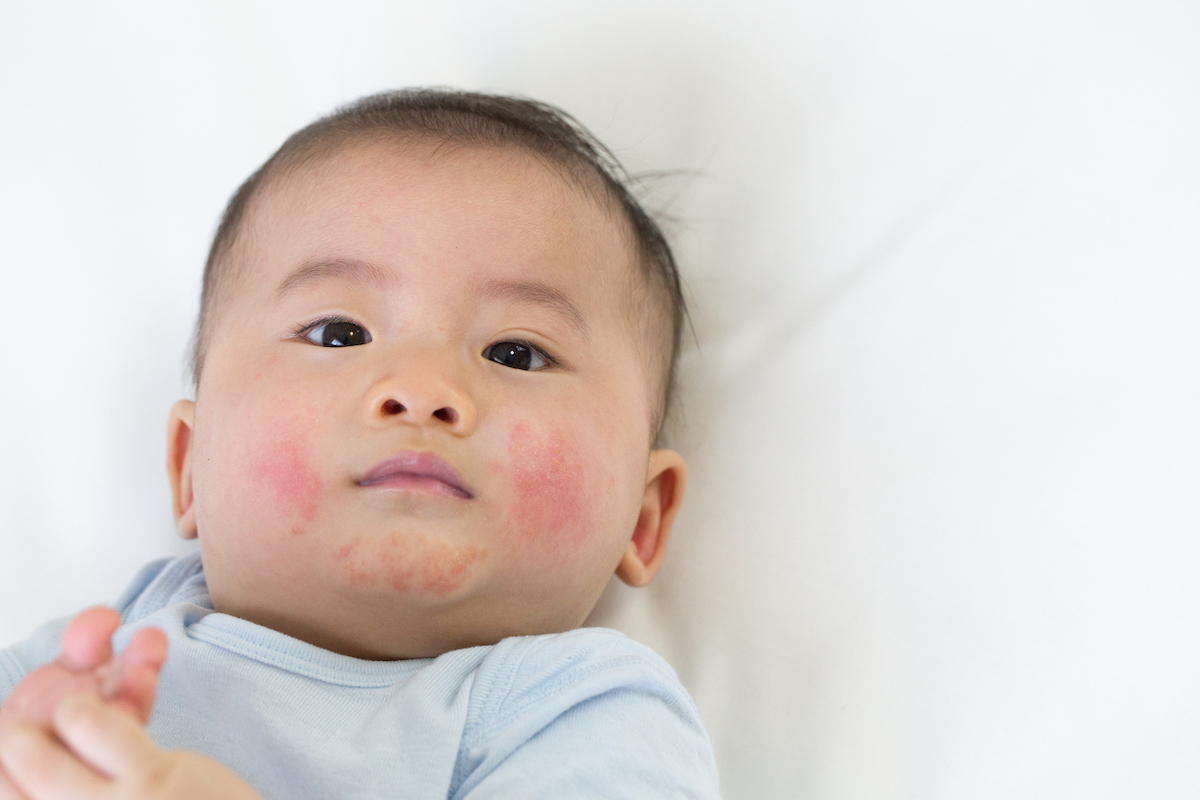 Allergies in Preschoolers: Top 5 Signs