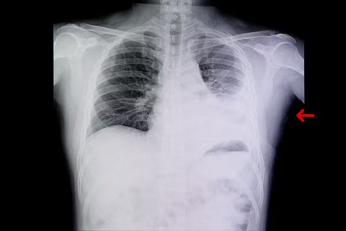 Crucial What Does A Thorax X Ray Normal Look Like?