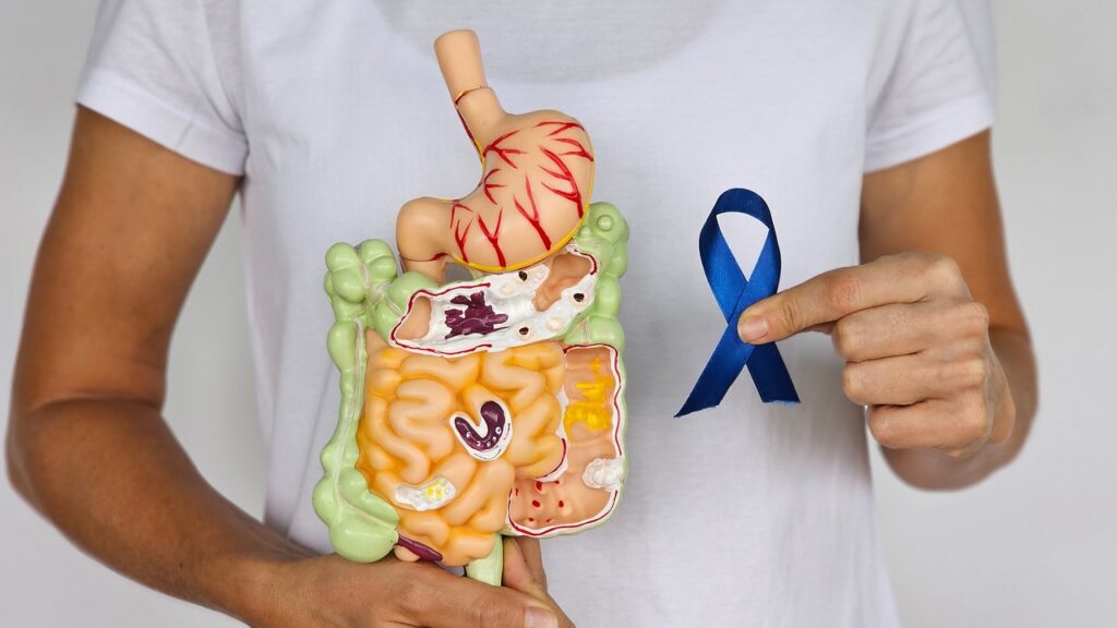 Colon Cancer Survival Rate: Long-Term Outlook 2 colon cancer survival rate