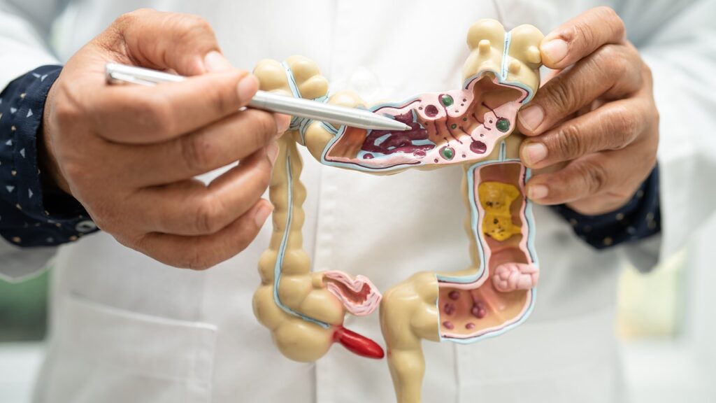 Colon Cancer Survival Rate: Long-Term Outlook 1 colon cancer survival rate