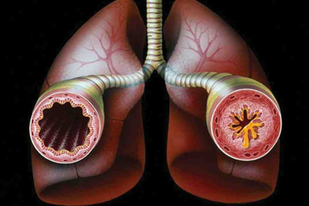 Signs of Bronchitis: When to See a Doctor