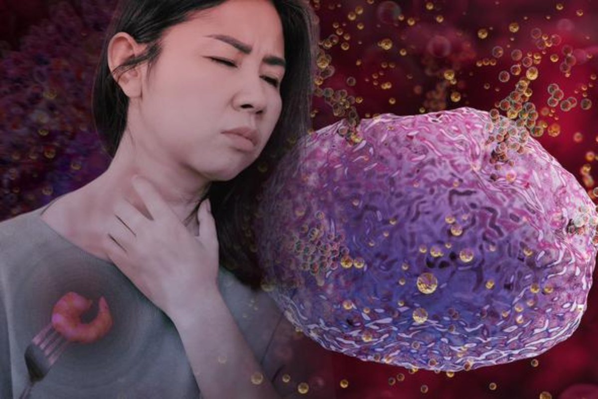 Anaphylaxis vs Anaphylactic Shock