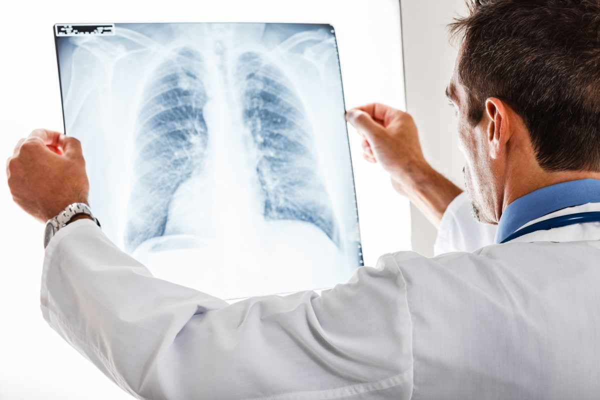 Can Bronchitis Kill You? Critical Facts