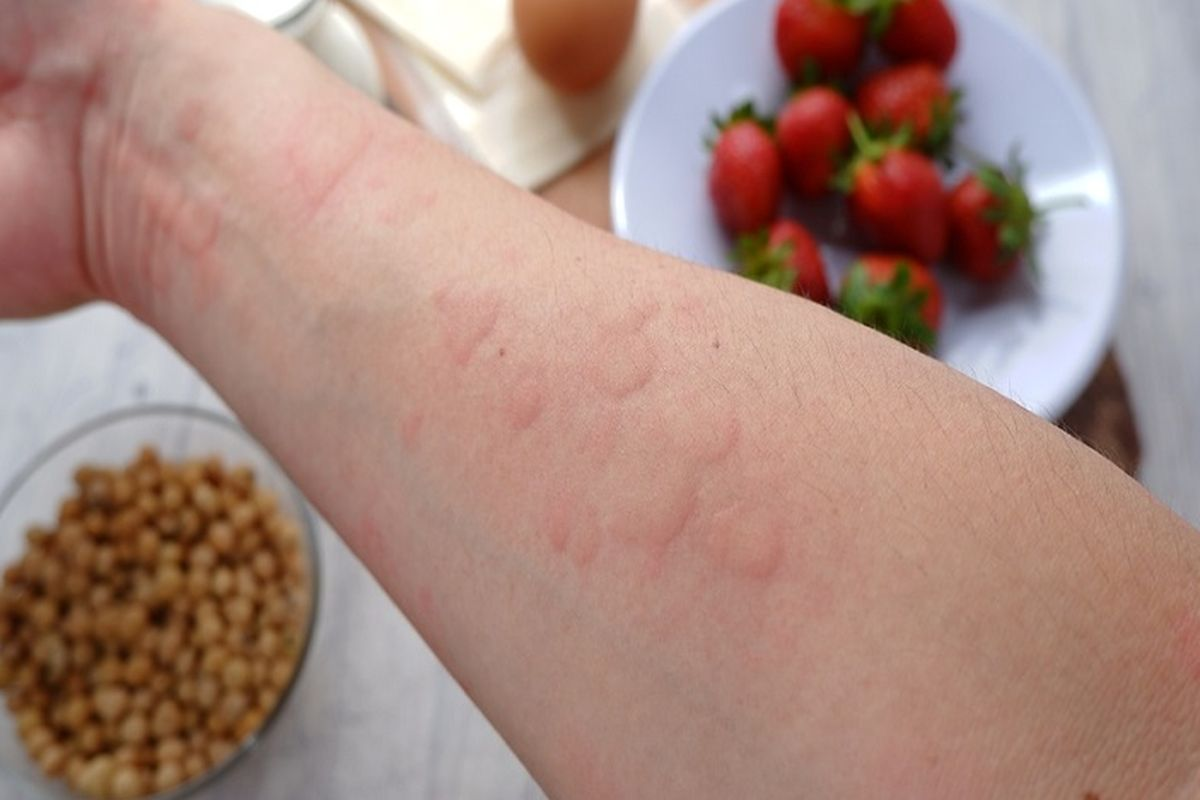 Allergic Reaction to Chicken: Signs
