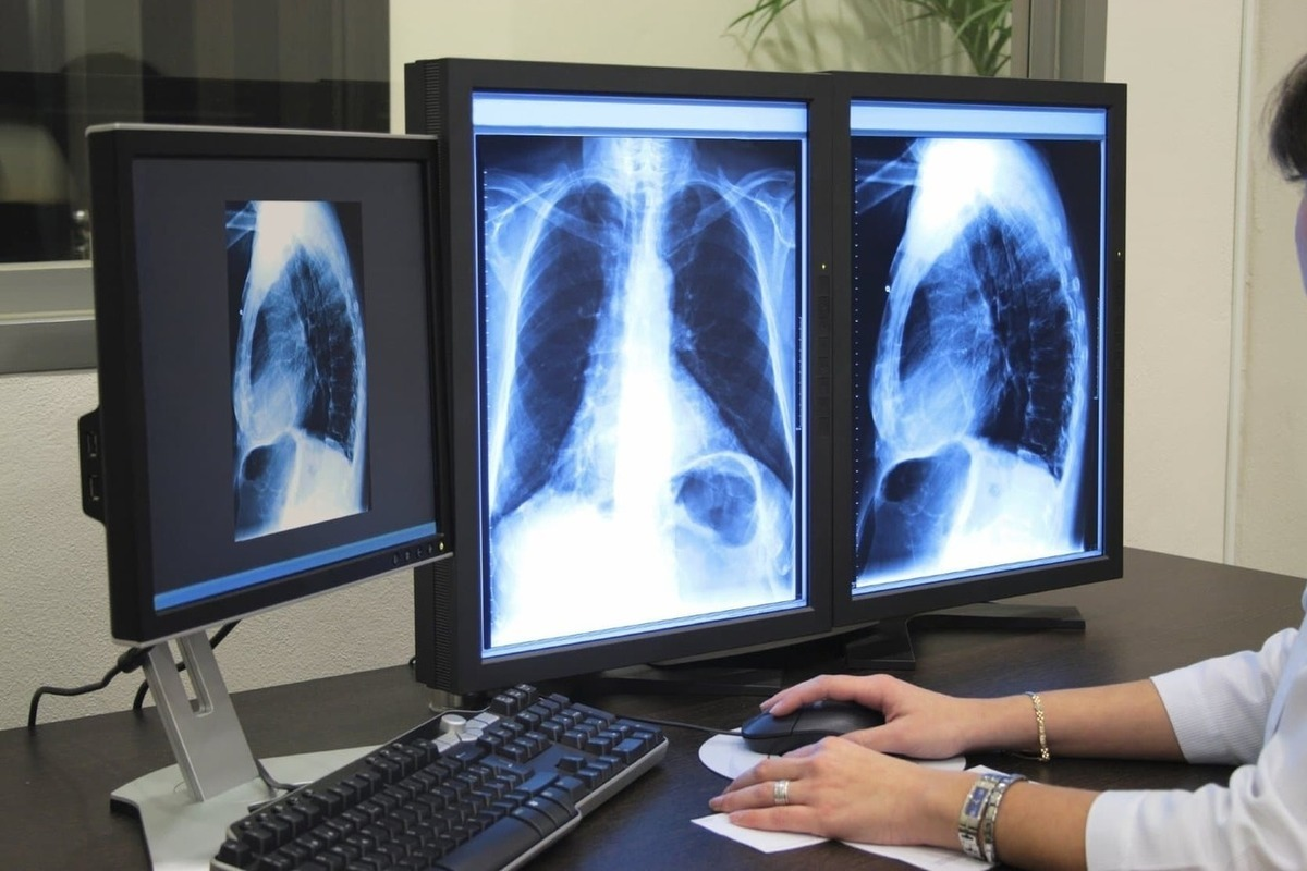 Key What Does A Normal Lung Xray Look Like Guide